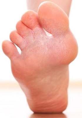 Can You Inherit Athlete's Foot?